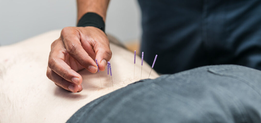 Dry Needling