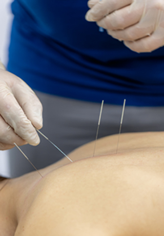 Dry needling therapy in Werribee